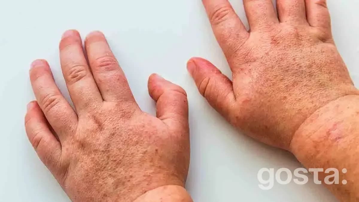 What Does Scarlet Fever Look Like In Children? 3 Main Symptoms