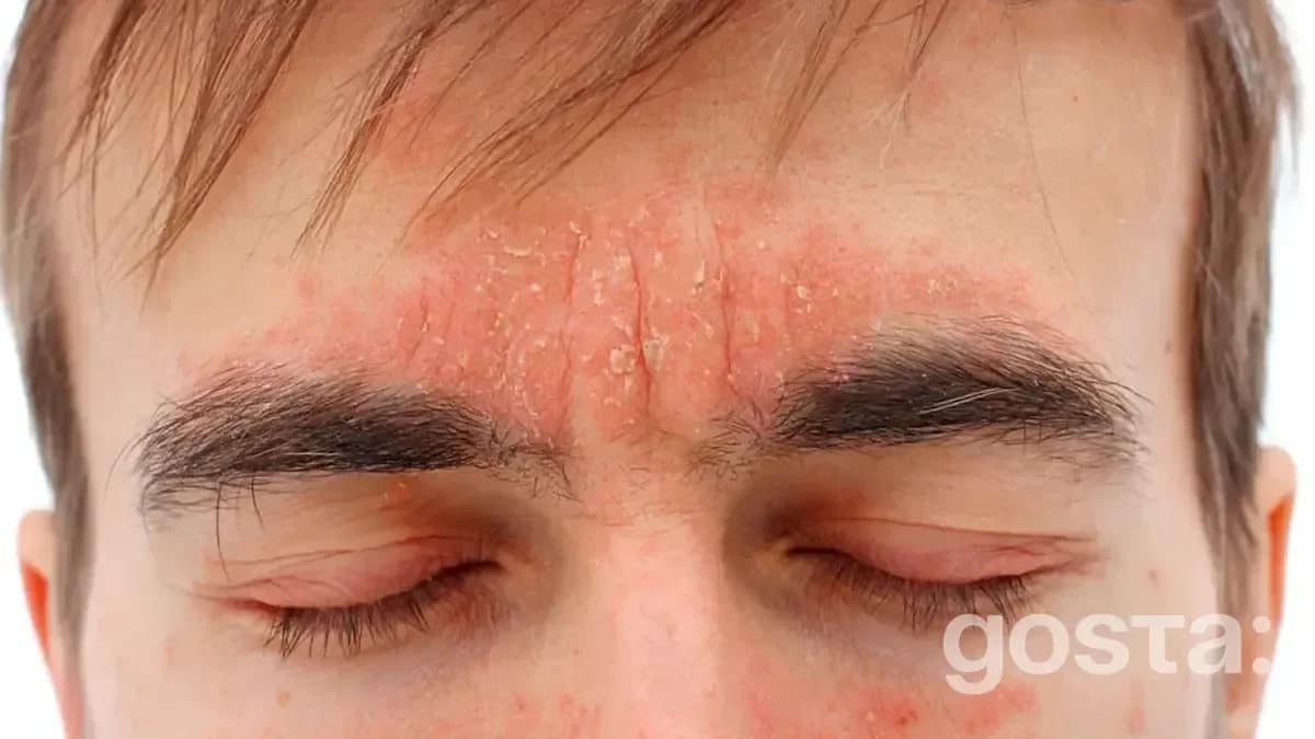 Чи може себорея на обличчі проявлятися у вигляді лупи?